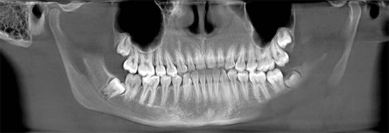 Что нужно знать перед имплантацией зубов? Подготовка к процедуре