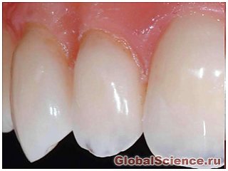 Обнаружен механизм борьбы зубов с инфекциями