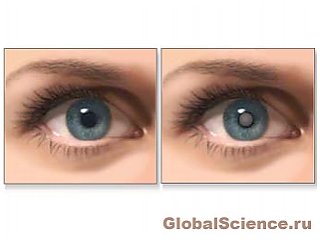 Ошибка в развитии глаза может стать причиной катаракты и глаукомы