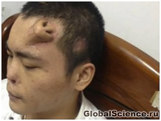 В Китае мужчине вырастили нос на лбу