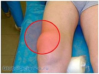 Врачи озабочены увеличением случаев заболеванием - гигрома коленного сустава