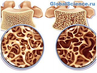 Новые результаты в лечении остеопороза приносит работа новосибирских ученых