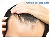 Обратная потеря волос с помощью микроигольных пластырей с лекарством от алопеции